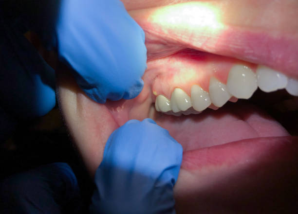 Teeth Whitening in FL